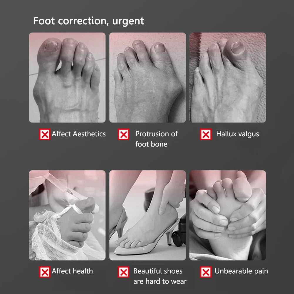 Correcteur d’Orteils – Attelle Orthopédique pour Hallux Valgus, Oignons et Orteils Croisés